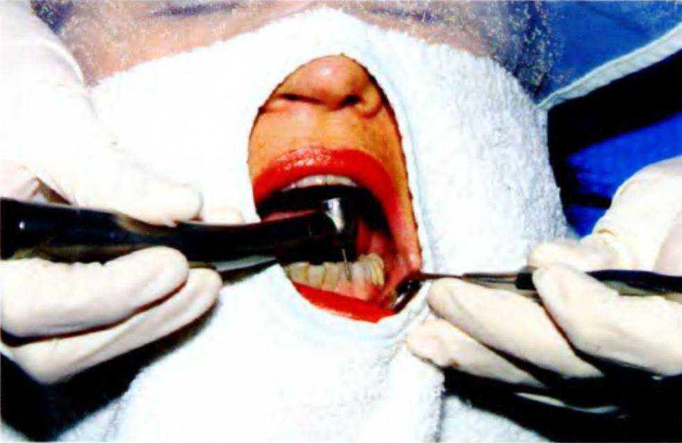 Положение врача при лечении зубов нижней челюсти