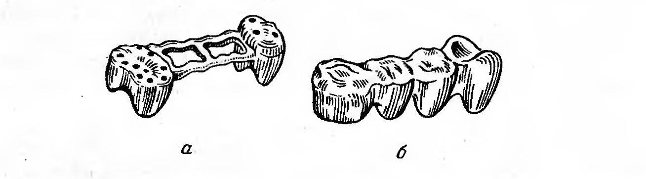 Части мостовидного протеза. Промежуточная часть несъемного мостовидного протеза. Цельнолитой мостовидный протез рисунок. Составной мостовидный протез. Составные мостовидные протезы.