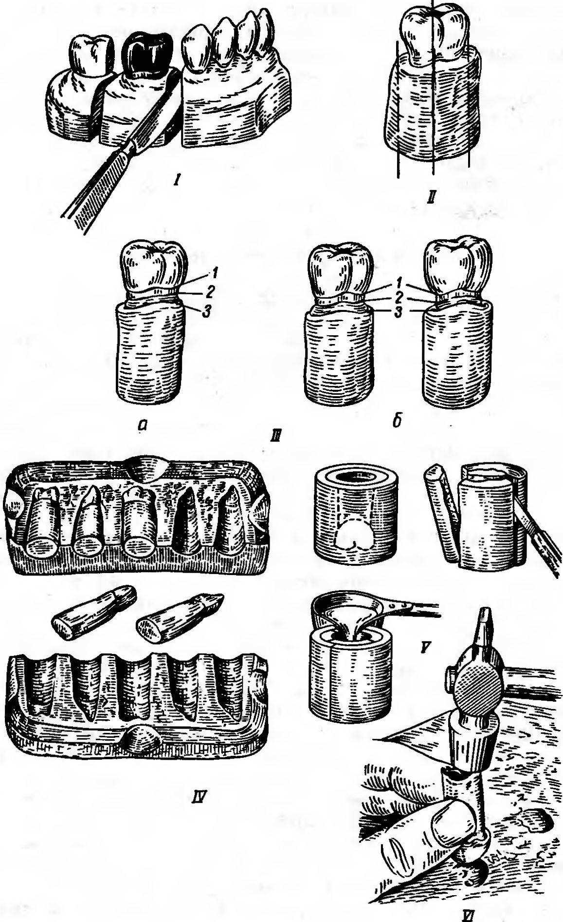 Этапы изготовления. Клинико-лабораторные этапы изготовления штампованных коронок. Клинико лабораторные этапы штампованной коронки. Этапы металлической штамповой коронки. Лабораторные этапы штампованных коронок.