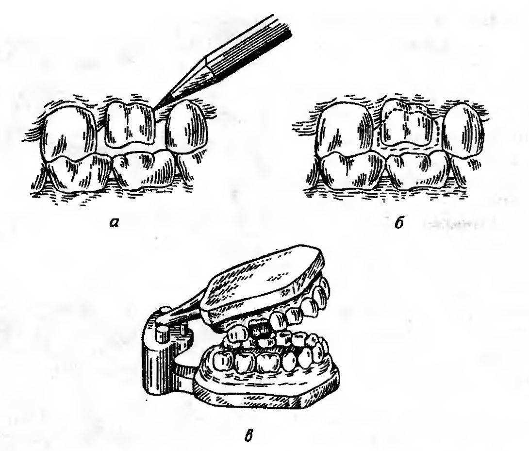 Изготовление штампованной. Этапы изготовления штампованных коронок. Очерчивание линии шейки зуба карандашом.. Моделирование штампованных коронок воском в окклюдаторе. Этапы изготовление металлических штампованных коронок.