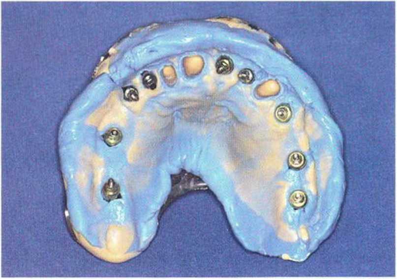 Ортопедический этап лечения. Красивые комбинированные оттиски зубов. Временных провизорных пластмассовых коронок.. Провизорные пластмассовые коронки. Монолитная модель челюсти с уровня оттиска.
