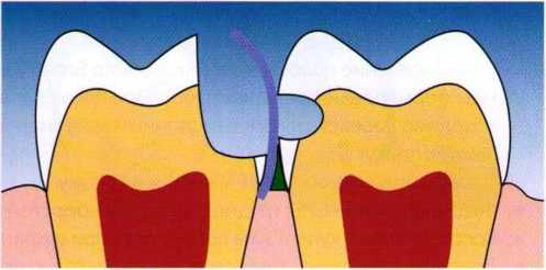 Сэндвич техника при лечении зубов