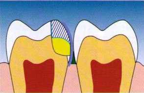 Сэндвич техника лечения зубов