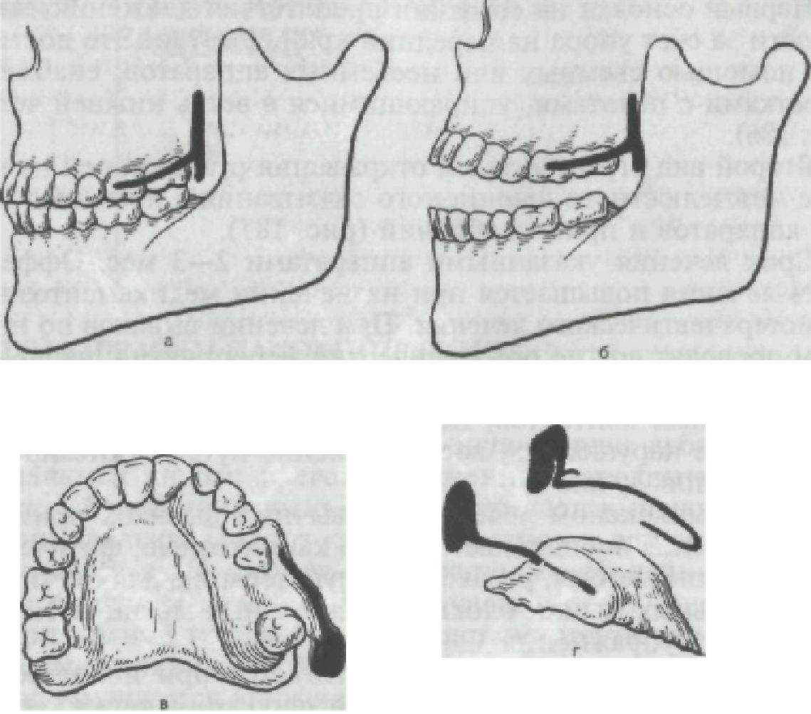 Вывих нижней челюсти. Аппарат Петросова вывих нижней челюсти. Аппарат Петросова для ВНЧС. Аппарат ядровой и Петросова.