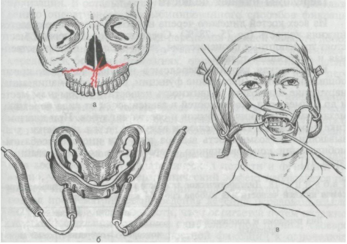 Суббазальный перелом верхней челюсти