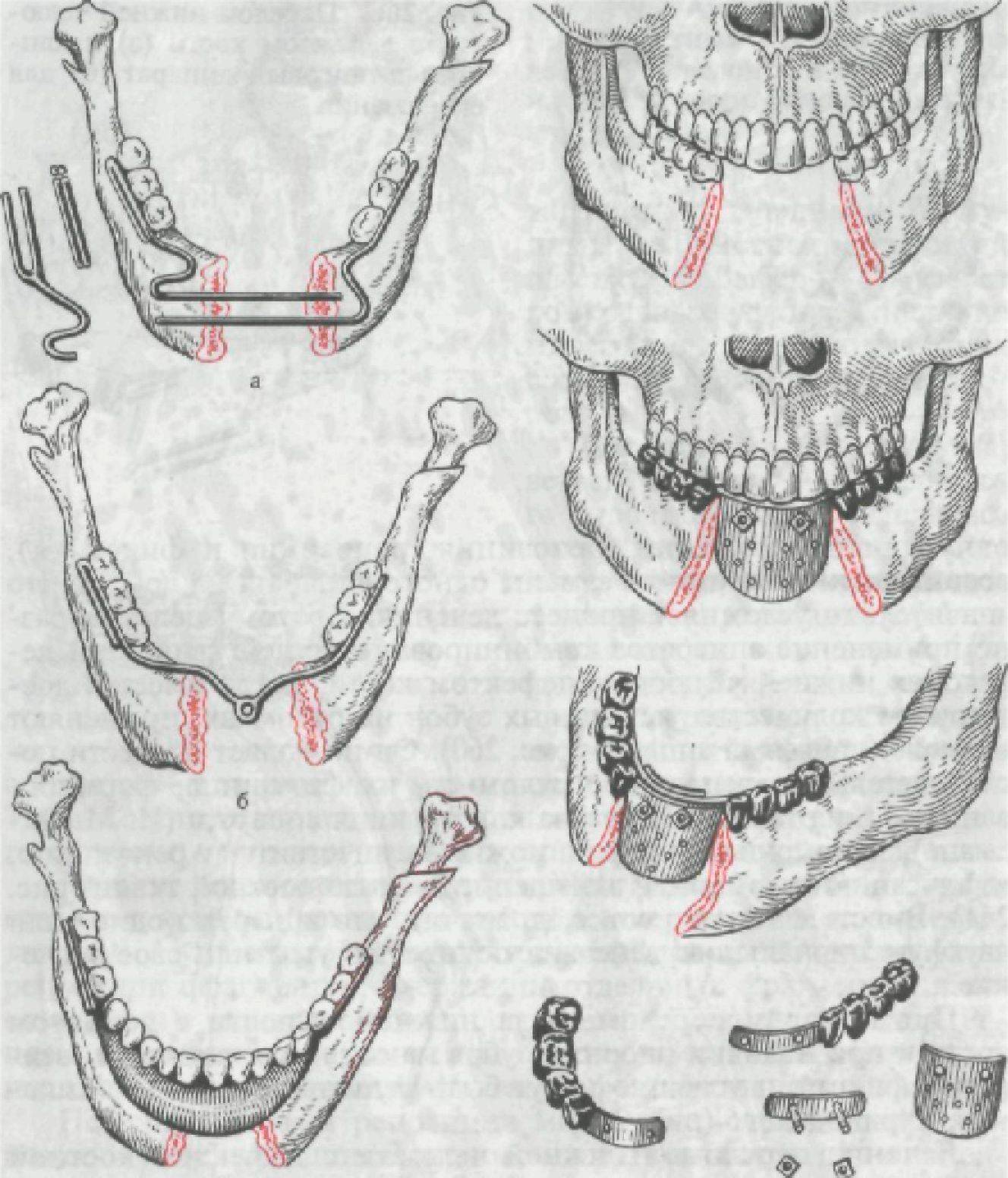 Лечение нижней челюсти. Переломы нижней челюсти челюстно лицевые аппараты. Классификация ложных суставов нижней челюсти по и.м.Оксману. Ангулярный перелом нижней челюсти. Осколочный перелом челюсти.