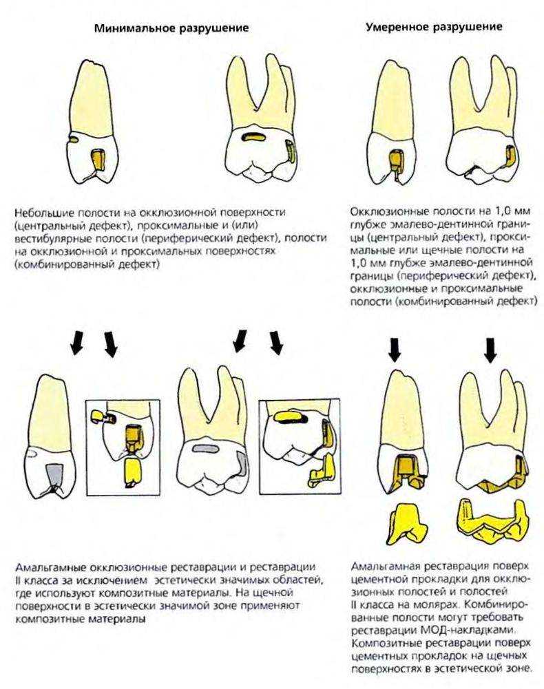Варианты восстановления. Препарирование под вкладки мод. Препарирование зуба под штифт. Препарирование полости мод. Препарирование 2 класса по Блэку.