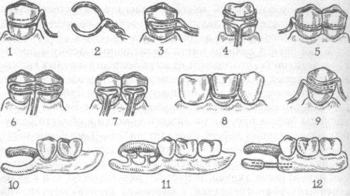 Окклюзионная накладка бюгельного протеза. Классификация кламмеров бюгельного протеза. Одноплечий кольцевой кламмер. Кламмер Аккера. Проволочный петлевидный кламмер.