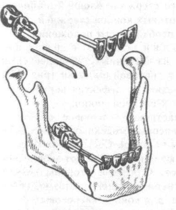 Аппарат для лечение перелома верхней челюсти