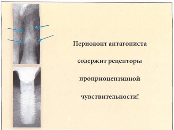 Перелом импланта