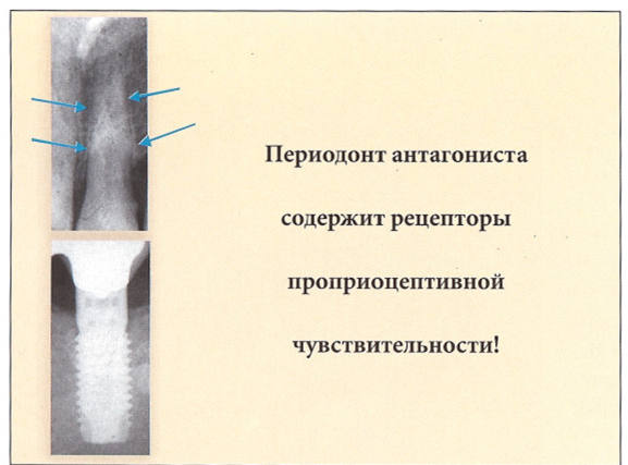 Перелом импланта