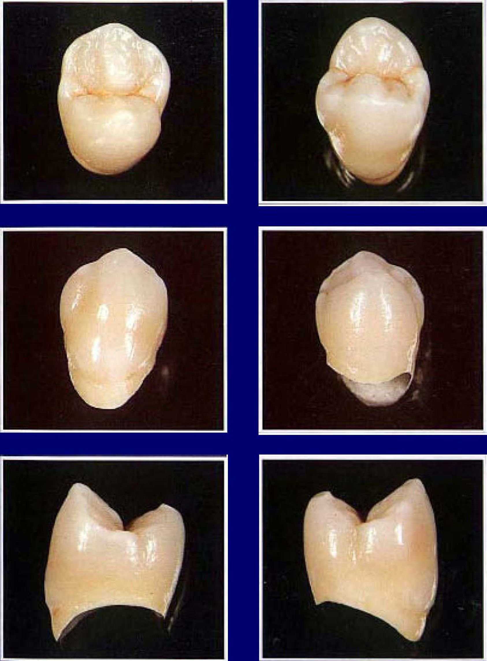 Клыки поверхность зуба. Анатомия 1 премоляра верхней челюсти. Второй премоляр нижней челюсти. Малый коренной зуб (премоляр).
