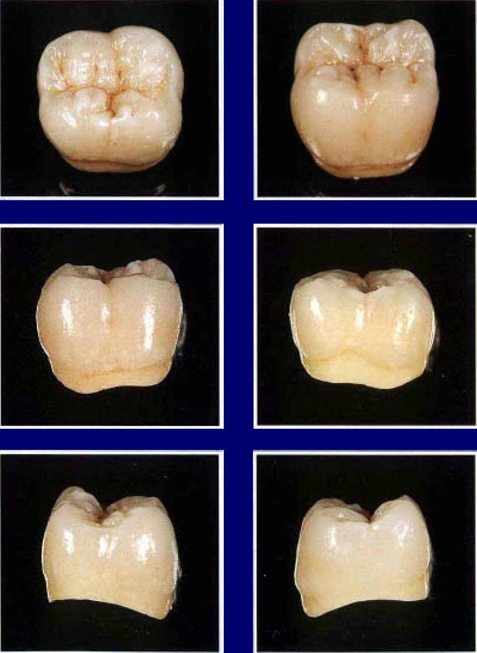 Зуб 47 - правый нижний второй моляр